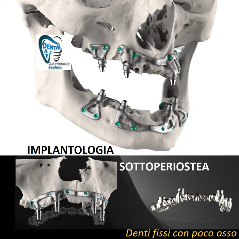 IMPLANTOLOGIA SOTTOPERIOSTEA